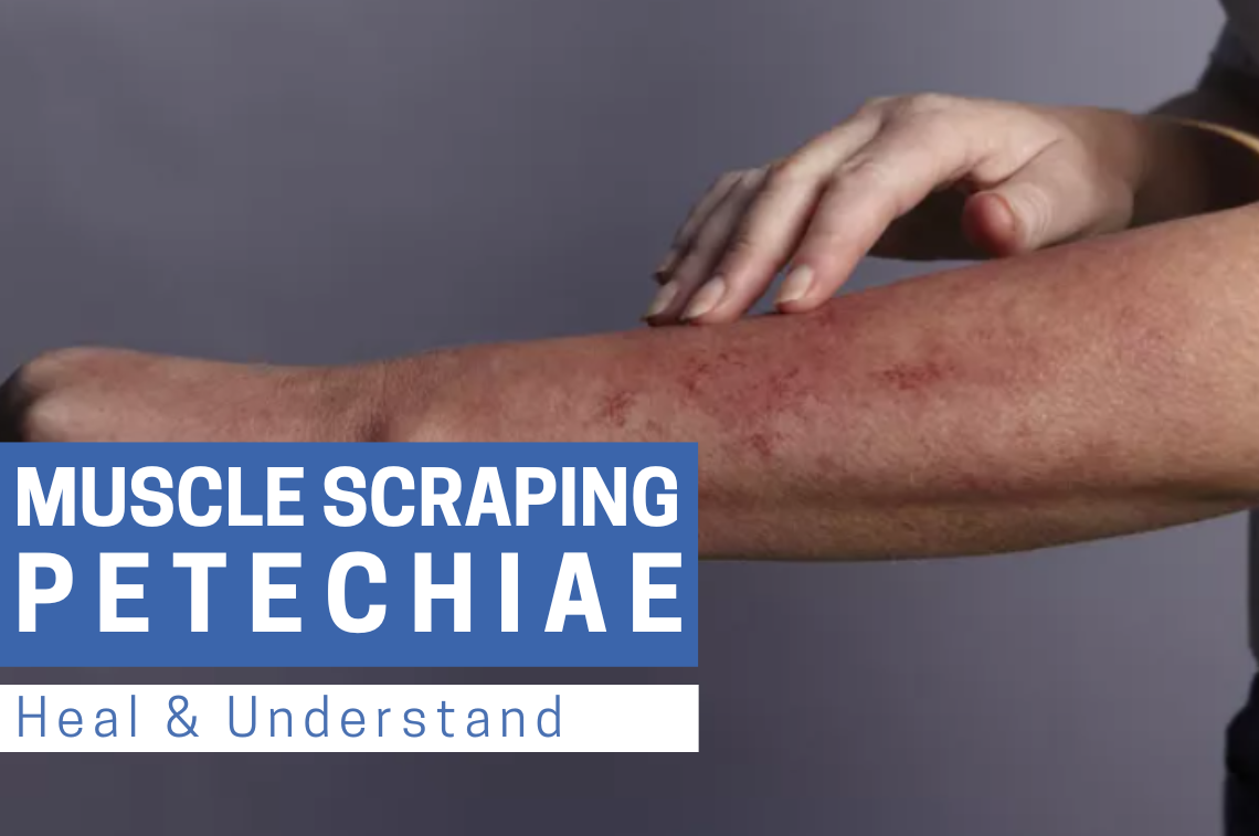 Muscle Scraping Petechiae: Heal & Understand | Bynatic